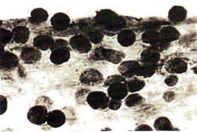 Малярний плазмодій   Тип Апікомплексні (Apicomplexa). Клас Споровики Sporozoea