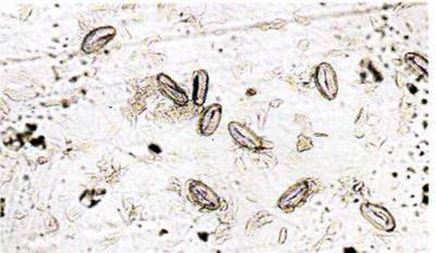 Гострик (Enterobius vermicularis)   Тип Круглі черви (Nemathelminthes)